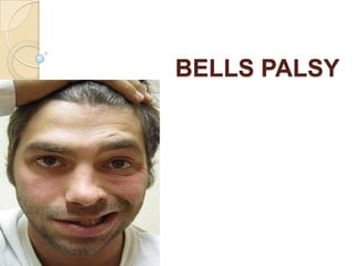 BELLS PALSY
 