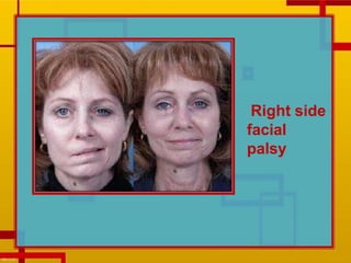 Right side
facial
palsy
 