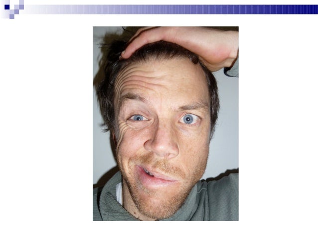 palsy face droop