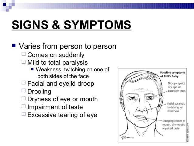 Bell S Palsy Ringing In Ear Bell S Palsy Ringing In Ear