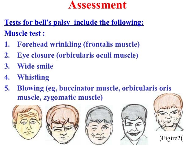 Facial Exercises For Bell S Palsy 112