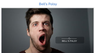 Bell’s Palsy
 