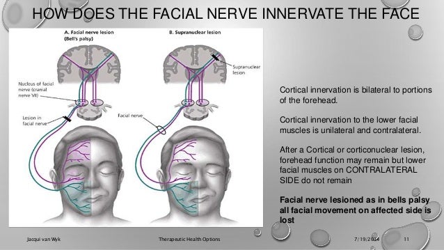 bell's palsy both sides