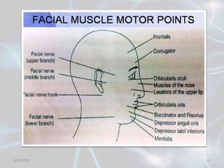 Motor points of face for electrical stimulation of bell's palsy