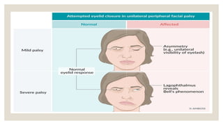 Bell's phenomenon anatomy mechanism clinical significance | PPTX