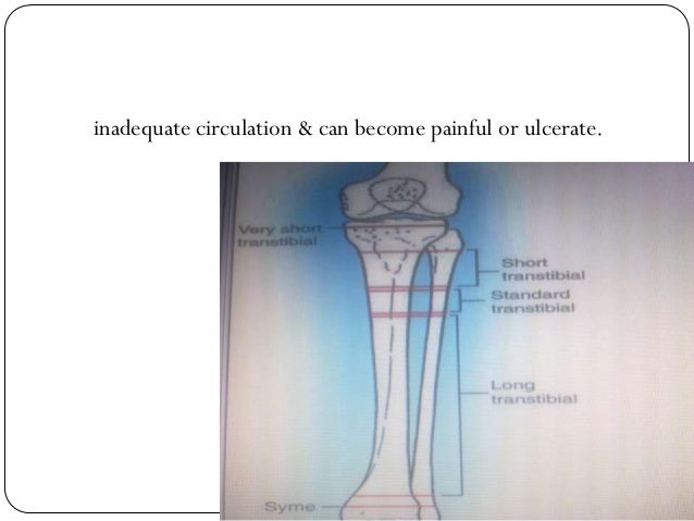 Below knee amputation Below knee amputation