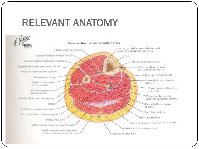 transtibial amputation