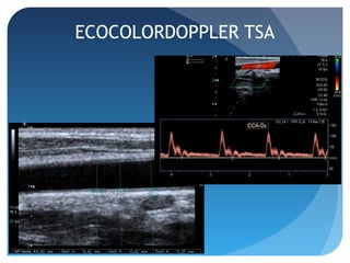 ECOCOLORDOPPLER TSA
 