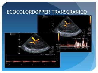 ECOCOLORDOPPER TRANSCRANICO
 