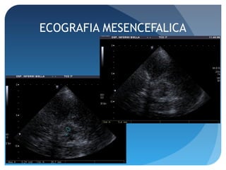 ECOGRAFIA MESENCEFALICA
 