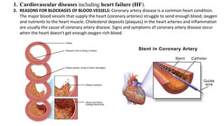 1. Cardiovascular diseases including heart failure (HF).
2. REASONS FOR BLOCKAGES OF BLOOD VESSELS: Coronary artery disease is a common heart condition.
The major blood vessels that supply the heart (coronary arteries) struggle to send enough blood, oxygen
and nutrients to the heart muscle. Cholesterol deposits (plaques) in the heart arteries and inflammation
are usually the cause of coronary artery disease. Signs and symptoms of coronary artery disease occur
when the heart doesn't get enough oxygen-rich blood.
 