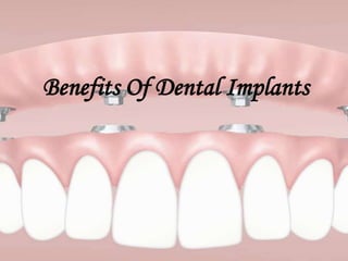 Benefits Of Dental Implants
 