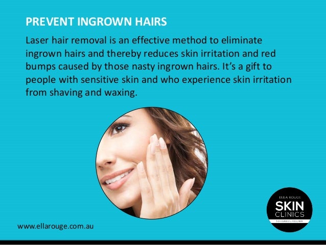 Benefits of Laser Hair Removal in Sydney