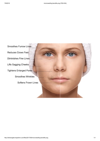 7/9/2018 microneedling-benefits.png (700×434)
http://drbrianglatt.nkpadmin.com/files/2017/09/microneedling-benefits.png 1/1
 