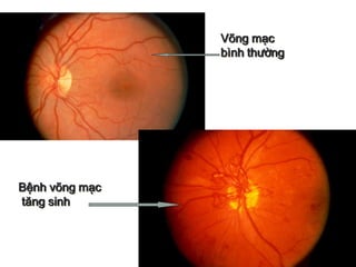 Võng mạc
bình thường
Bệnh võng mạc
tăng sinh
 