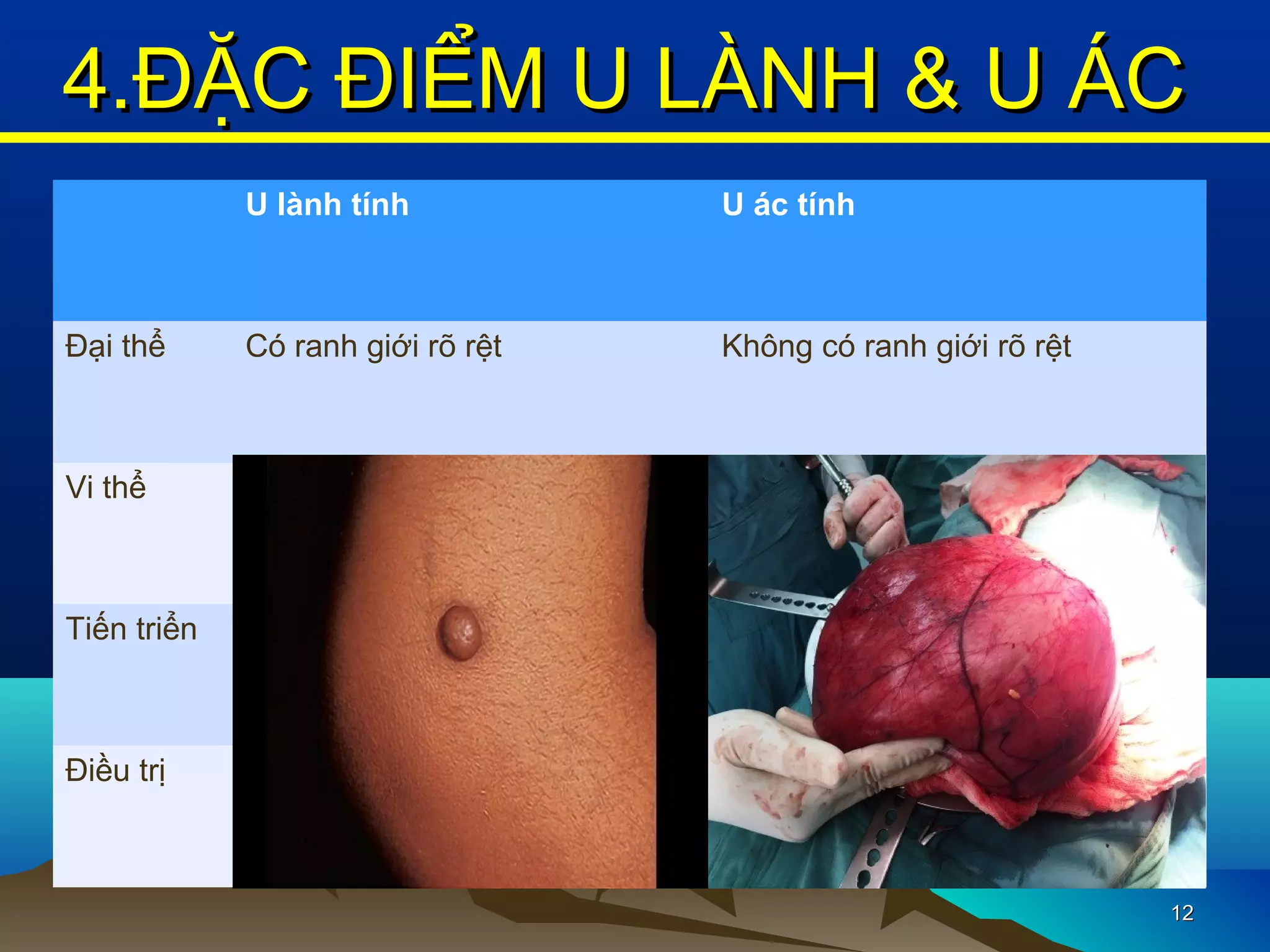 1212
4.ĐẶC ĐIỂM U LÀNH & U ÁC4.ĐẶC ĐIỂM U LÀNH & U ÁC
U lành tính U ác tính
Đại thể Có ranh giới rõ rệt Không có ranh giới rõ rệt
Vi thể Giống mô bình thường Không giống mô bình thường
Tiến triển Phát triển tại chỗ và chậm
Không di căn
Phát triển nhanh
Di căn
Điều trị Khỏi hẳn khi được cắt bỏ Dễ tái phát, khó điều trị
 