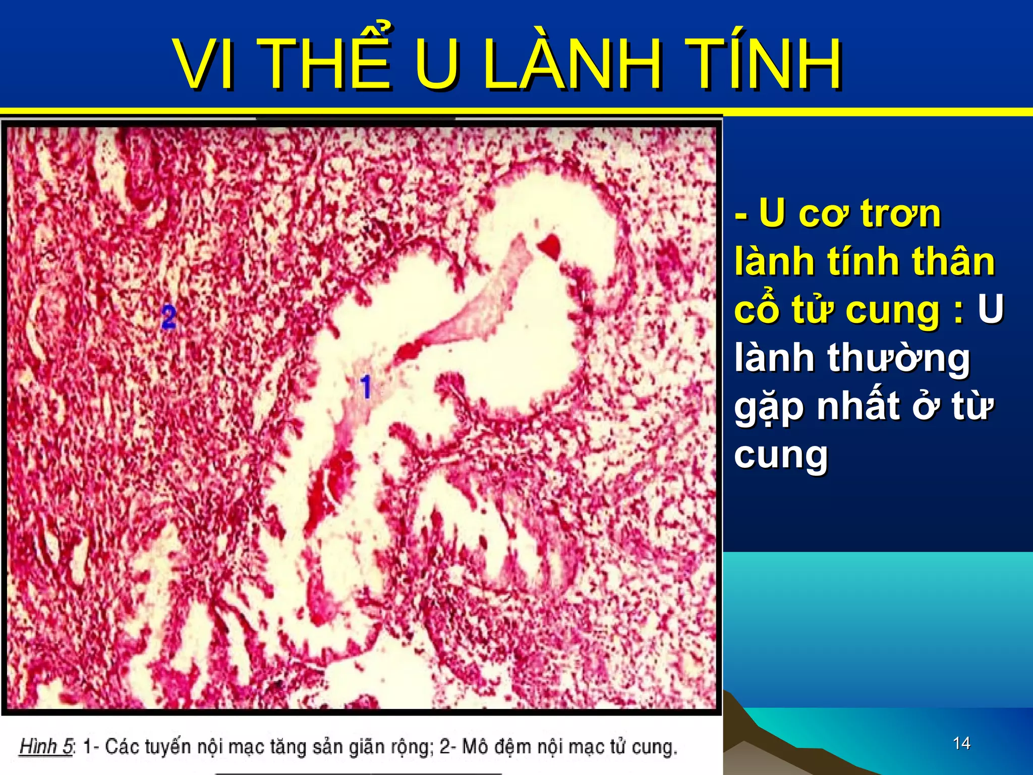 1414
VI THỂ U LÀNH TÍNHVI THỂ U LÀNH TÍNH
- U cơ trơn- U cơ trơn
lành tính thânlành tính thân
cổ tử cung :cổ tử cung : UU
lành thườnglành thường
gặp nhất ở từgặp nhất ở từ
cungcung
 