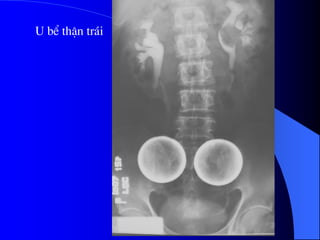 U bÓ thËn tr¸i
 