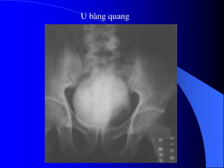U bµng quang
 