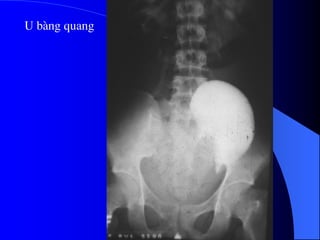 U bµng quang
 