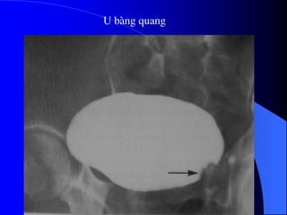 U bµng quang
 