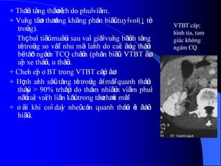 + Tháûn tàng thãø têch do phuì viãm.
+ Vuìng täøn thæång khäng phán biãût tuyí voí (↓ tè
troüng).
Thç baìi tiãút muäün sau vaìi giåì vuìng bãûnh tàng
tè troüng so våïi nhu mä laình do caïc äúng tháûn
bë tàõc ngáúm TCQ cháûm (phán biãût: VTBT äø,
aïp xe tháûn, u tháûn.
+ Cheìn eïp ÂBT trong VTBT cáúp äø.
+ Hçnh aính såüi tàng tè troüng åí måî quanh tháûn
tháúy > 90% trhåüp do thám nhiãùm viãm phuì
nãö caïc vaïch liãn kãút trong täø chæïc måî.
+ Âäi khi coï daìy nheû cán quanh tháûn êt âàûc
hiãûu.
VTBT cÊp:
h×nh tia, tam
gi¸c kh«ng
ngÊm CQ
 