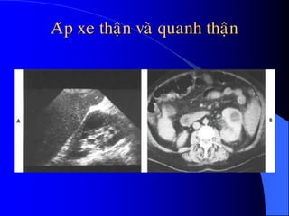 Aùp xe thaän vaø quanh thaän
 