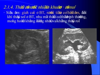 2.1.4. Tháûn æï næåïc nhiãùm khuáøn - æï muí
- Siãu ám: giaîn caïc ÂBT, næåïc tiãøu coï häöi ám, âäi
khi tháúy soíi ÂBT, nhu mä tháûn coï thãø bçnh thæåìng,
moíng hoàûc khäng âäöng nháút vaì khäng tháúy roî.
 
