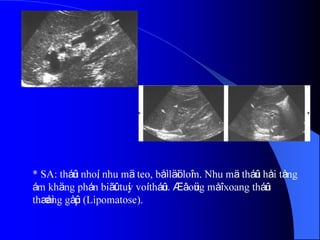 * SA: tháûn nhoí, nhu mä teo, båì läöi loîm. Nhu mä tháûn håi tàng
ám khäng phán biãût tuíy voí tháûn. ÆÏ âoüng måî xoang tháûn
thæåìng gàûp (Lipomatose).
 