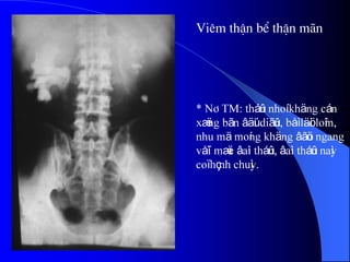 Viªm thËn bÓ thËn m·n
* NÂTM: tháûn nhoí khäng cán
xæïng bãn âäúi diãûn, båì läöi loîm,
nhu mä moíng khäng âãöu ngang
våïi mæïc âaìi tháûn, âaìi tháûn naìy
coï hçnh chuìy.
 