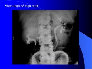 Viªm thËn bÓ thËn m·n
 