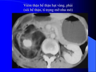 Viªm thËn bÓ thËn h¹t vµng, ph¶i
(sái bÓ thËn, tØ träng mì nhu m«)
 