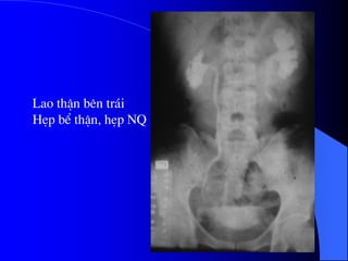 Lao thËn bªn tr¸i
HÑp bÓ thËn, hÑp NQ
 