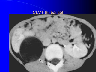 CLVT thì bài tiết
 