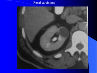 Renal carcinoma
 