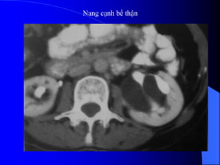 Nang cạnh bể thận
 
