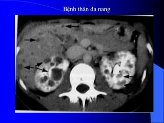 Bệnh thËn ®a nang
 