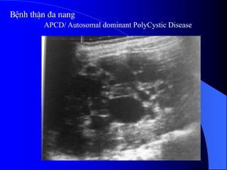 APCD/ Autosomal dominant PolyCystic Disease
Bệnh thËn ®a nang
 