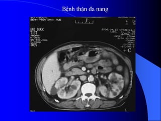 Bệnh thËn ®a nang
 