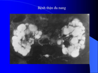 Bệnh thËn ®a nang
 