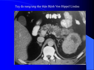 Tuỵ đa nang/ung thư thận Bệnh Von Hippel Lindau
 