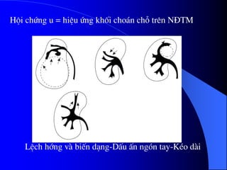 LÖch híng vµ biÕn d¹ng-DÊu Ên ngãn tay-KÐo dµi
Héi chøng u = hiÖu øng khèi cho¸n chç trªn N§TM
 