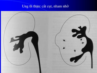 Ung th thËn: c¾t côt, nham nhë
 