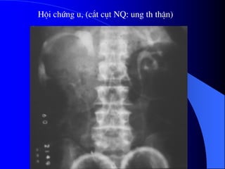 Héi chøng u, (c¾t côt NQ: ung th thËn)
 