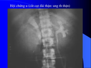 Héi chøng u (c¾t côt ®µi thËn: ung th thËn)
 
