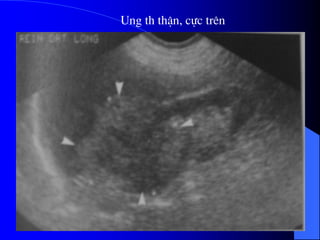 Ung th thËn, cùc trªn
 