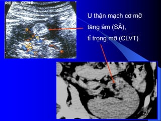 U thËn m¹ch c¬ mì
t¨ng ©m (S¢),
tØ träng mì (CLVT)
 