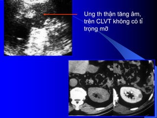 Ung th thËn t¨ng ©m,
trªn CLVT kh«ng cã tØ
träng mì
 
