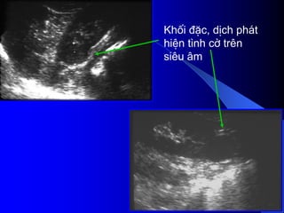 Khèi ®Æc, dÞch ph¸t
hiÖn t×nh cê trªn
siªu ©m
 