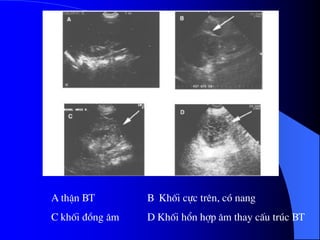 A thËn BT B Khèi cùc trªn, cã nang
C khèi ®ång ©m D Khèi hæn hîp ©m thay cÊu tróc BT
 